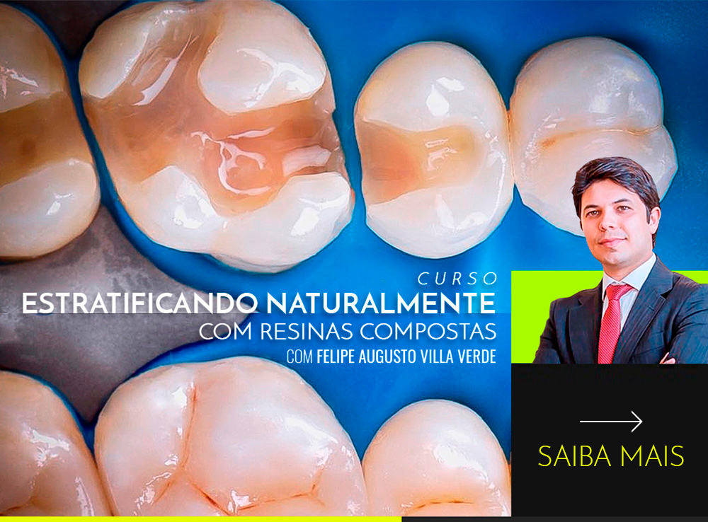 Estratificando Naturalmente com Resinas Compostas