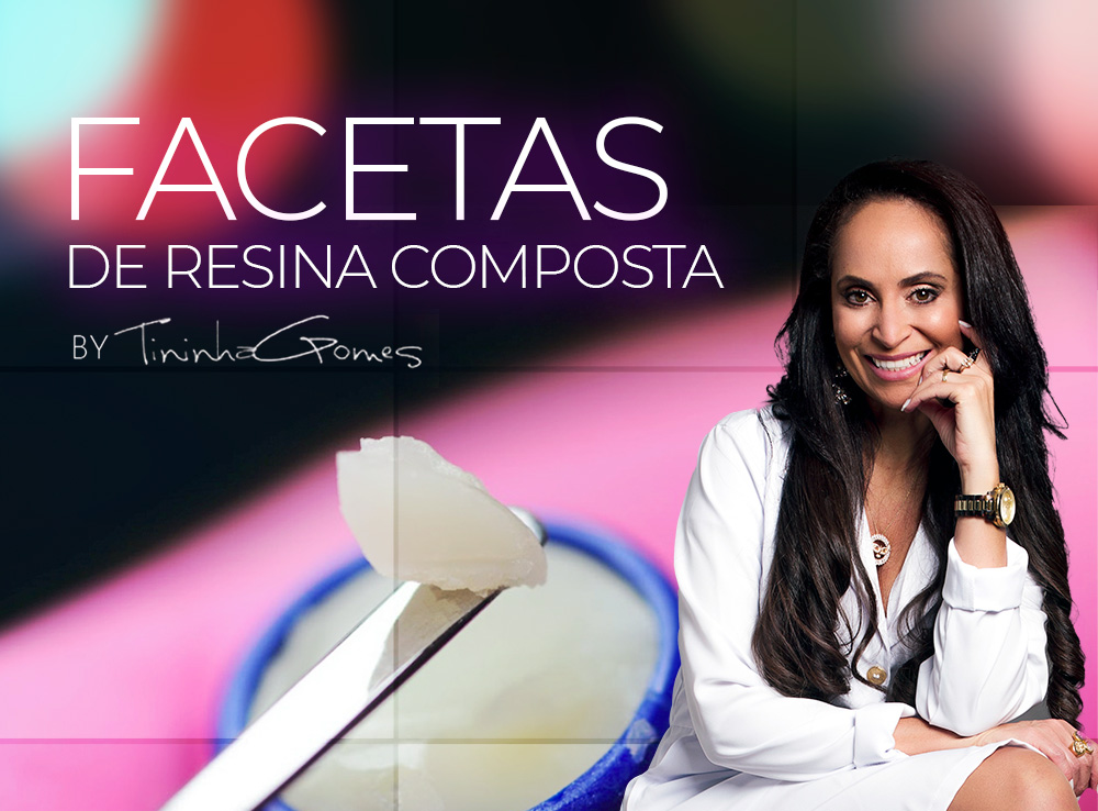 Facetas de Resina Composta