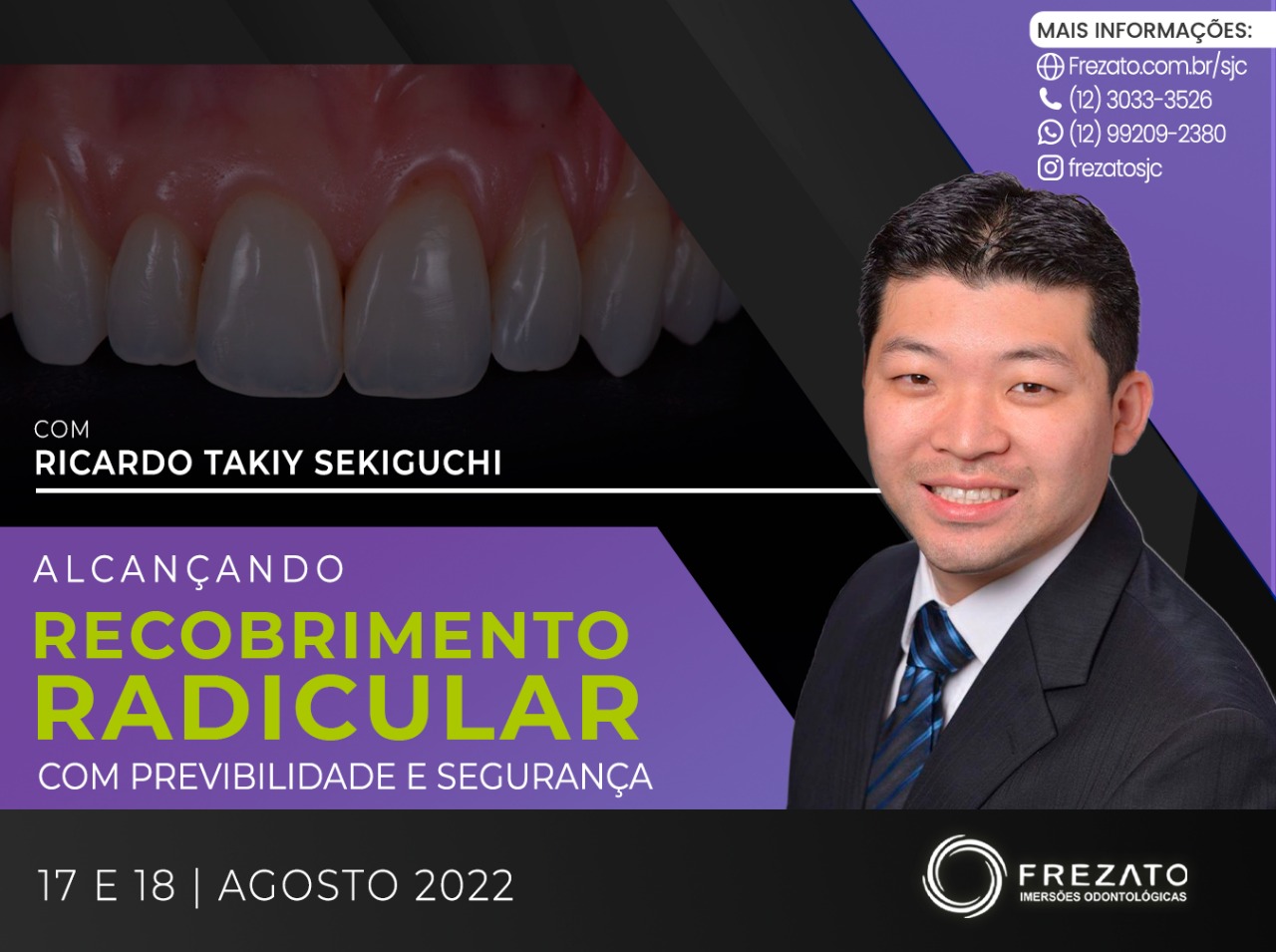 Alcançando recobrimento radicular com previbilidade e segurança.